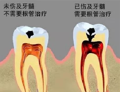 蛀牙治疗需要多久