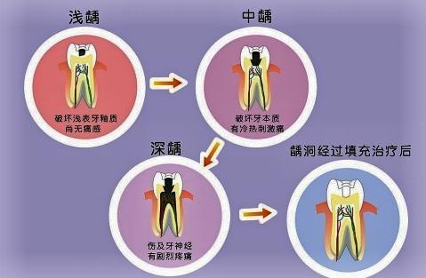 蛀牙了一定要做根管治疗吗