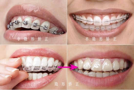 成都成华区牙齿矫正多少钱