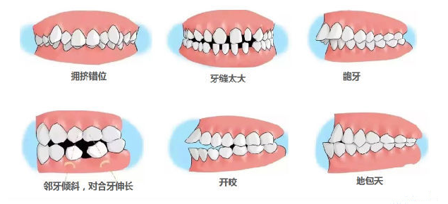 成都矫正牙齿不齐推荐圣贝医院