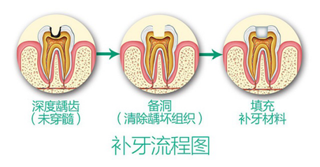 成都圣贝牙科医院补牙要多少钱