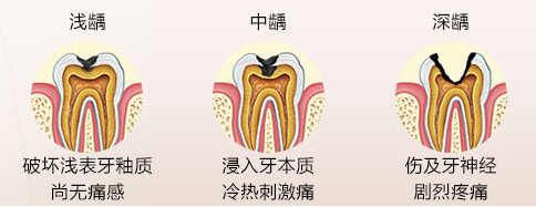 成都圣贝牙科医院补牙要多少钱